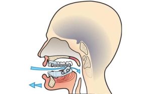apnees sommeil diagnostic haguenau Orthèse d’Avancée Mandibulaire (OAM) Centre du Sommeil Respire