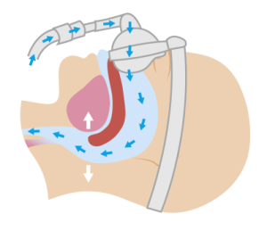 apnees sommeil solutions respire Pression Positive Continue (PPC) Centre du Sommeil Respire